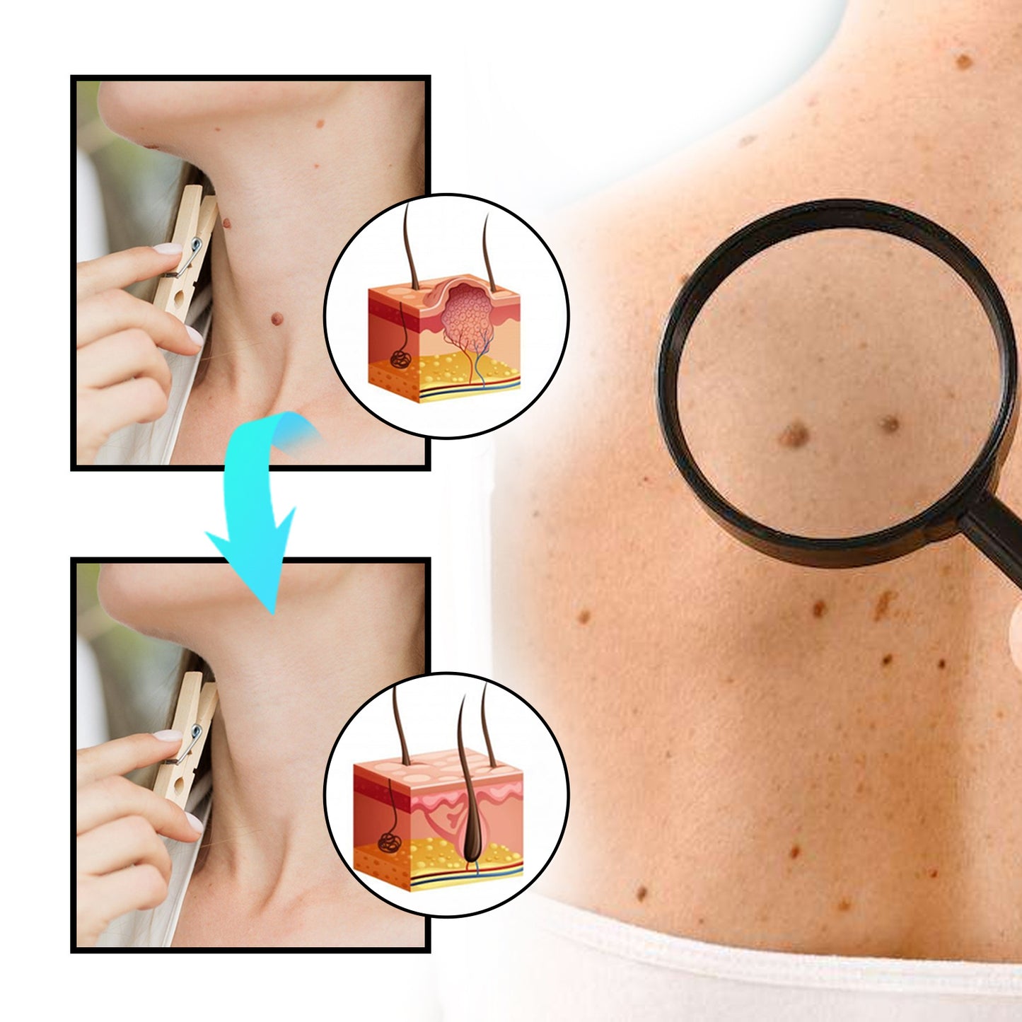 Ximonth Bee Venom Wart Care Spray Clean and fade body moles, smooth skin, and repair spray