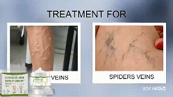 EELHOE Leg Repair Cream Relieve Leg Discomfort Massage Leg Vein Protrusion Pulse Health Repair Cream