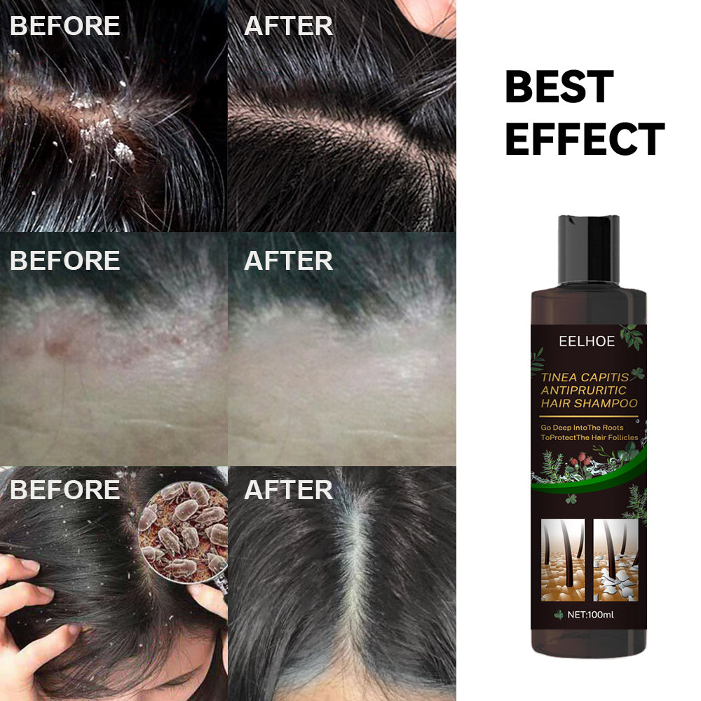 EELHOE Anti-Dandruff Itch Relief Shampoo Anti-shedding Refreshing Oil Control Hair Care Anti-dandruff Anti-itch Shampoo